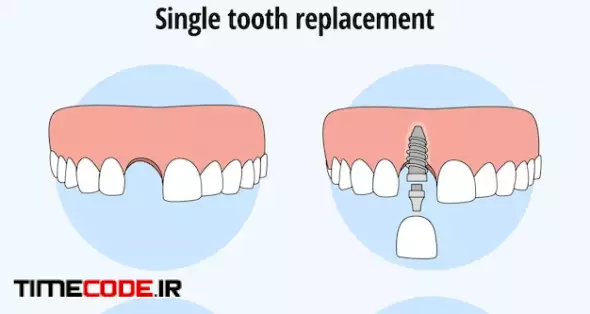 Single Tooth Replacement Dental Implant